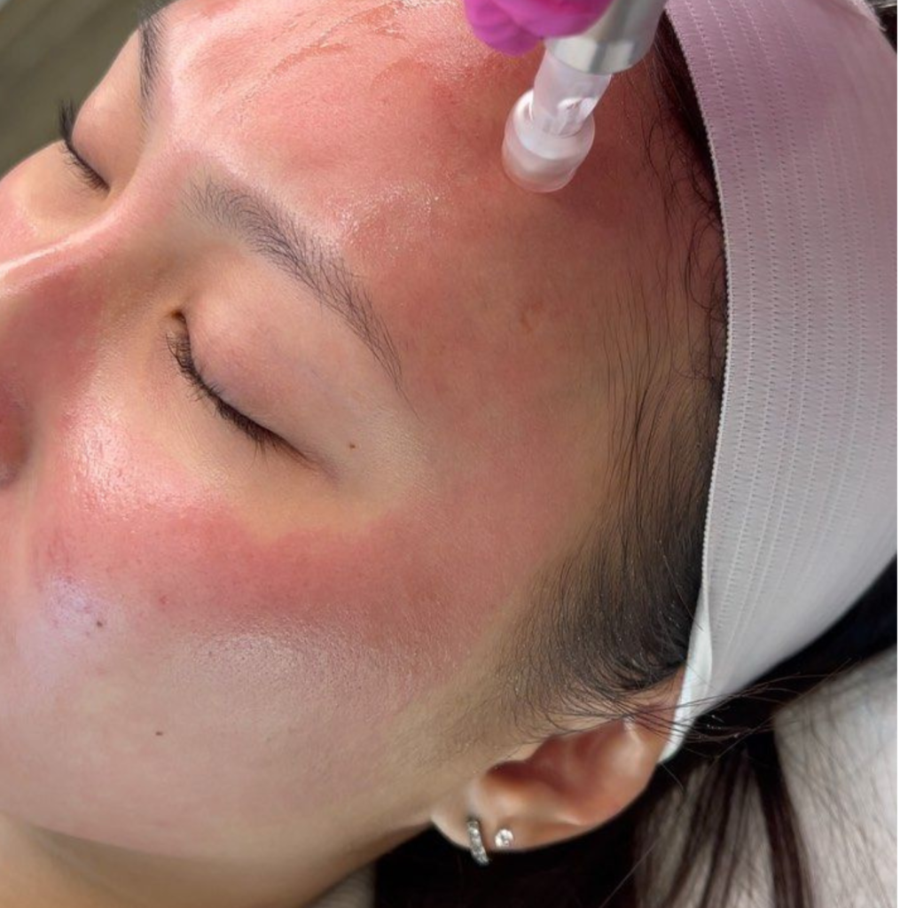 Medifacial for glowing skin in Jabalpur