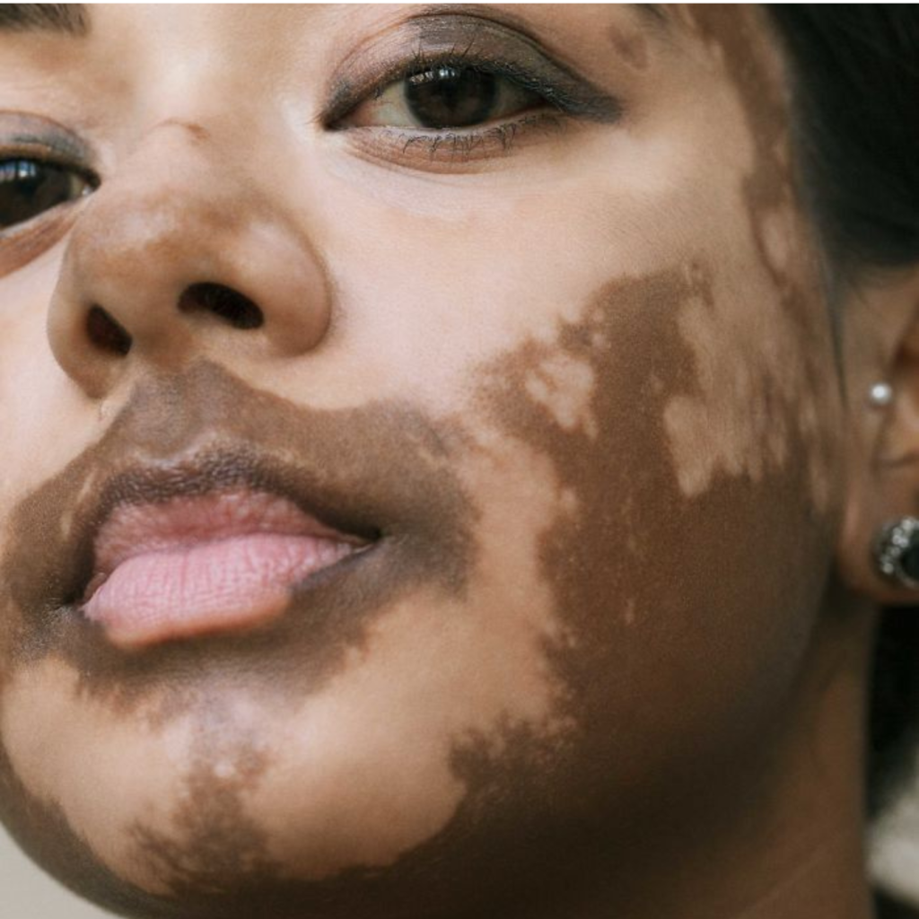 Vitiligo Treatment in Jabalpur