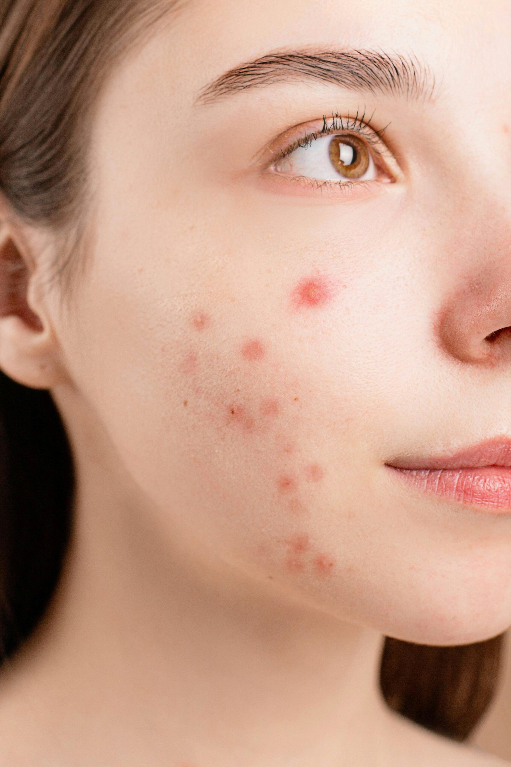 Acne & Scar Treatment in Jabalpur